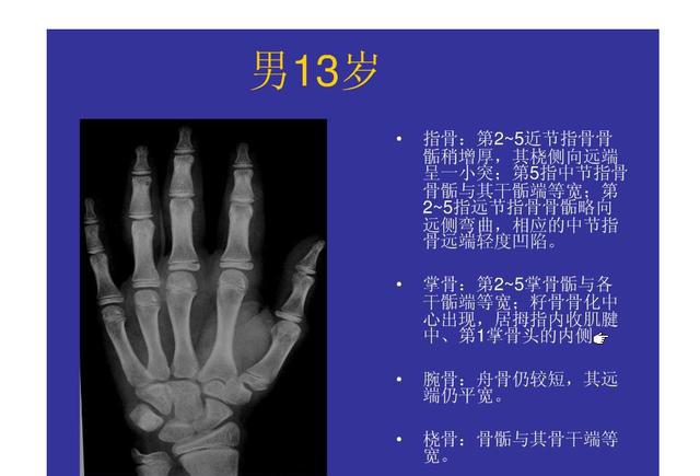 想知道孩子能长多高吗骨科干货儿童骨龄检测对照表