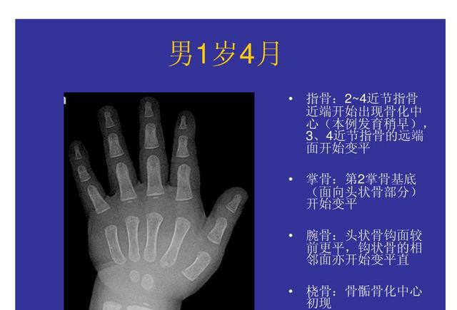 基层儿保科如何快速完成骨龄评估并保证结果可靠性？