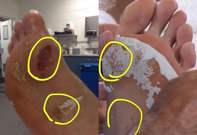 郑泫晒右脚血肉模糊图 网友质疑:不该是左脚吗