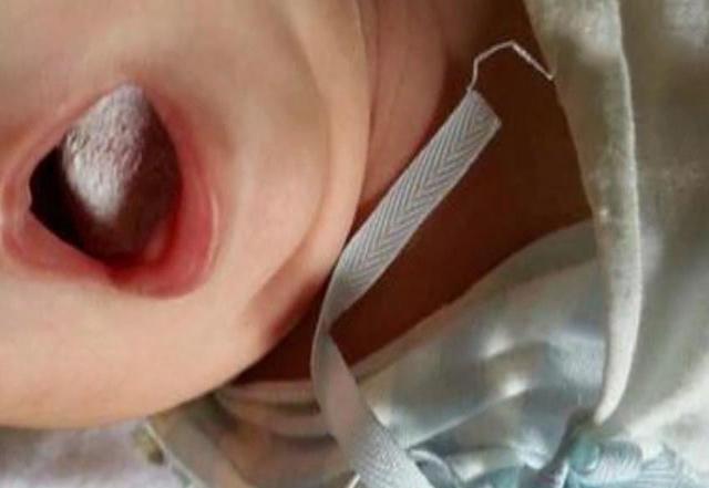 商业保险败血症 宝宝得过败血症商业保险能报销吗