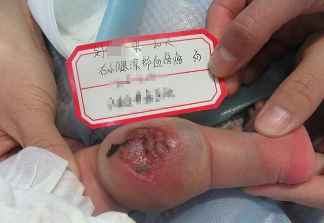 老人血管瘤破了危险吗 血管瘤破了危险吗