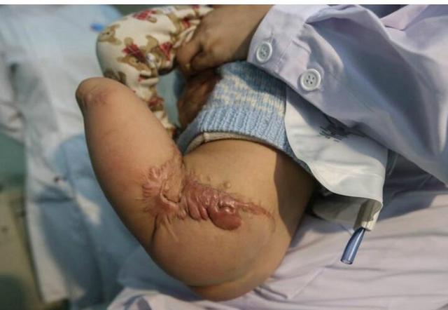 虽然已经痊愈,但是疤痕体质给他带来巨大痛苦,再加上尿道的不断堵塞