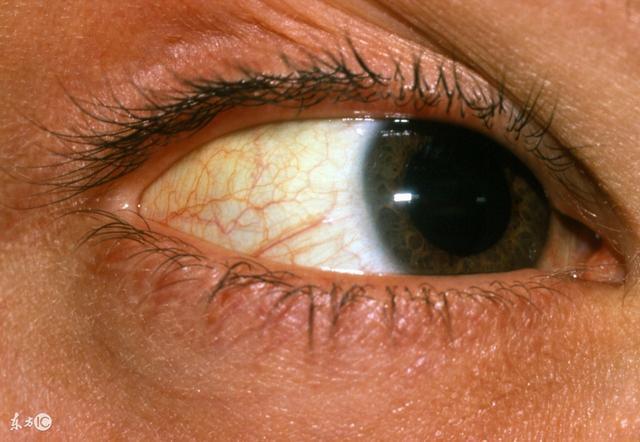 医生提醒:肝病不痛不痒,可身上出现这5种征兆,却是癌变信号!