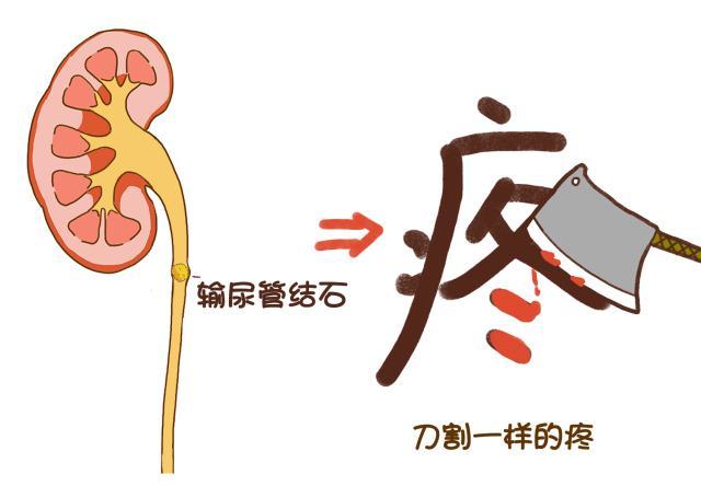 漫画教你如何跟尿路结石说拜拜