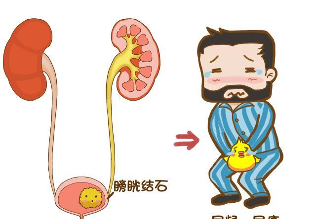 漫画教你如何跟尿路结石说拜拜