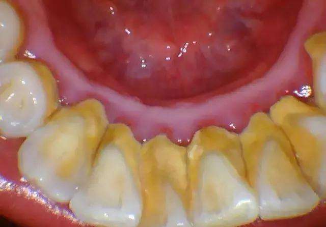 牙结石主要有两种龈上牙结石,也叫可见牙结石,一般是覆盖在牙缝,牙背