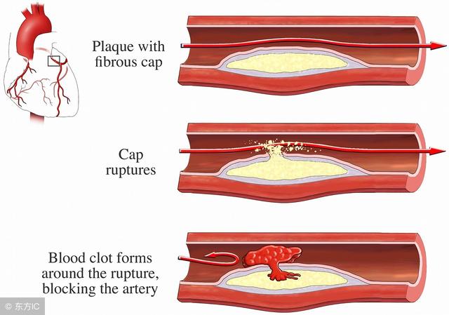 动脉粥样硬化|斑块|血管_新浪网