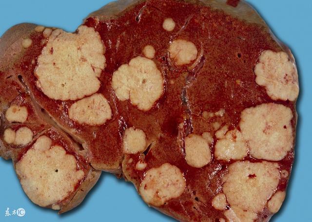 25岁女大学生确诊肝癌, 医生全力抢救未挽回, 7天后离世|肝癌|女大学