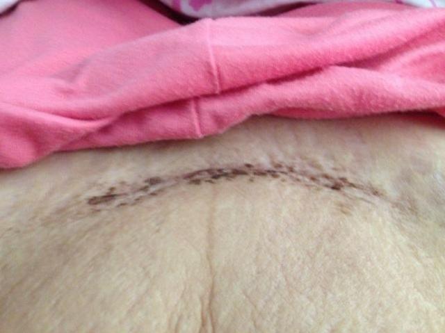 剖腹产之后,一个法子让孕妈身体上的伤疤,变得充满魅力!