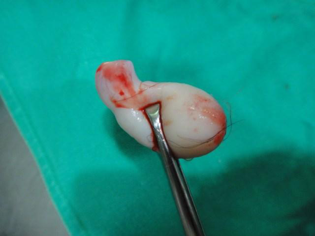 生完孩子子宫还没恢复好,就又怀孕了,胆子真大.