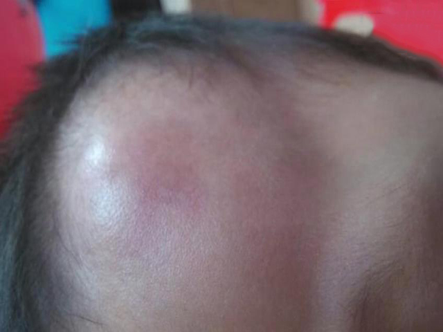 半夜宝宝突然大哭起来,小张开灯一看宝宝滚到地上,头上起了很大一个包