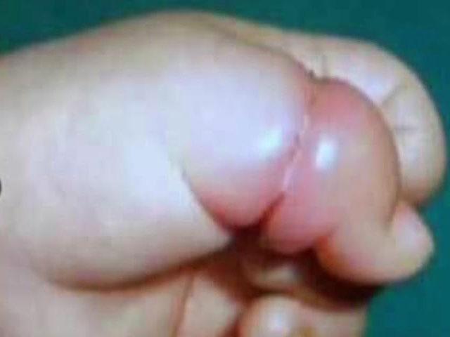 未满月的宝宝哭闹不止,医生看到手指吓出汗,差点"被截肢"