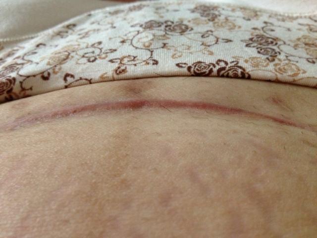 剖腹产两个月后,产妇伤口突然流水,护士检查完脸都吓白了