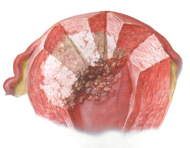 盆腔磁共振报告和术后病例显示她换上了子宫内膜样腺癌晚期