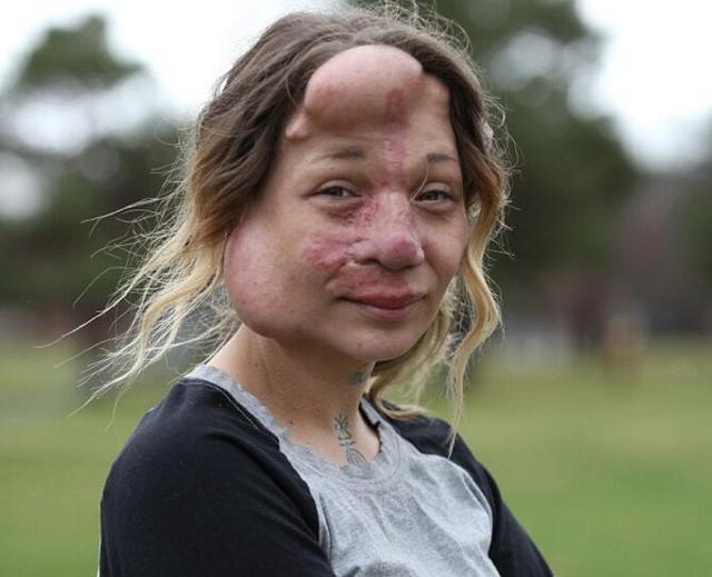 美国28岁女子患罕见疾病脸部畸形,丈夫却对她一见钟情