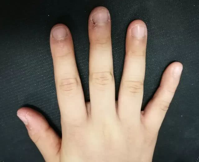 啃手指的危害图片