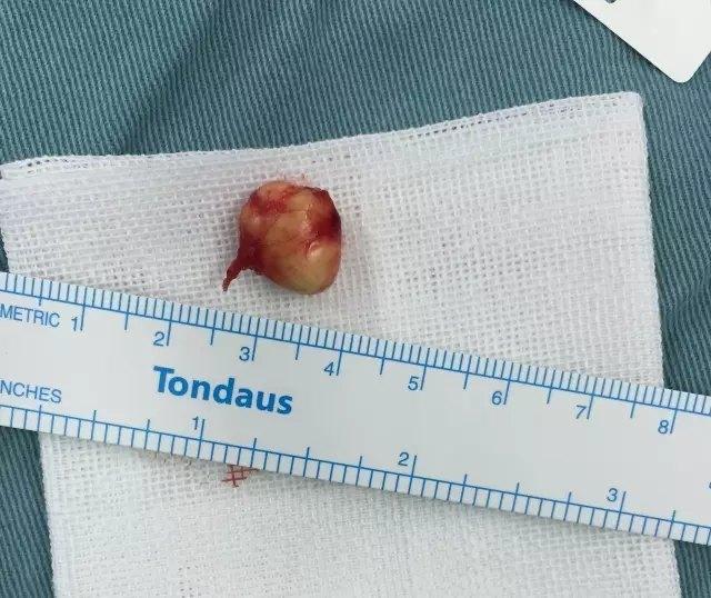 表皮样囊肿是怎么回事如何治疗