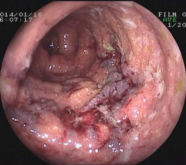 大便后回头看一下,发现便便有这3个变化,说不定能救你一命|结肠癌