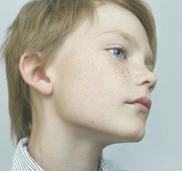 雀斑|孩子|父母_新浪新闻
