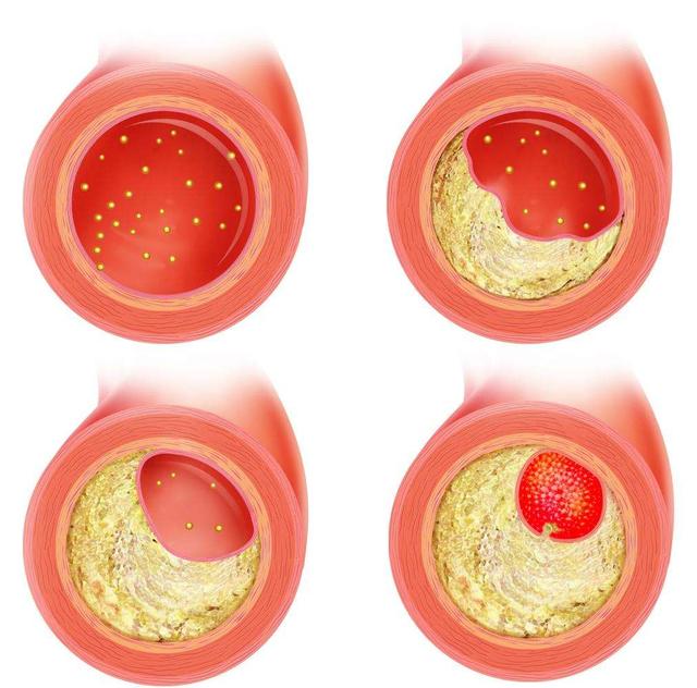 血管堵没堵,1个小测试就能知道,3个饮食方法,越吃血管越通畅
