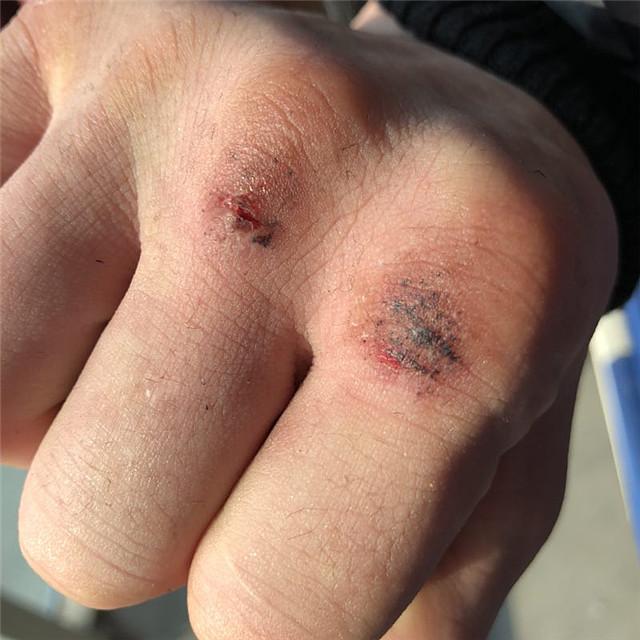 离比赛还有两天,邱建良的拳头却受伤了