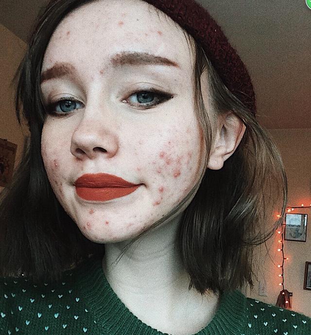 美国女孩满脸粉刺仍自信展现缺陷美