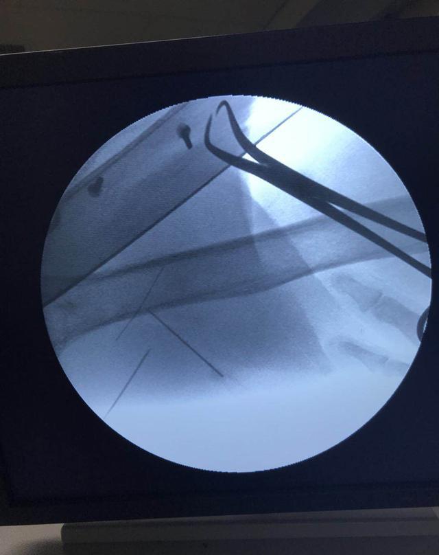 都是"断针"惹的祸!八十岁老太私人诊所针灸"针"上手术台!