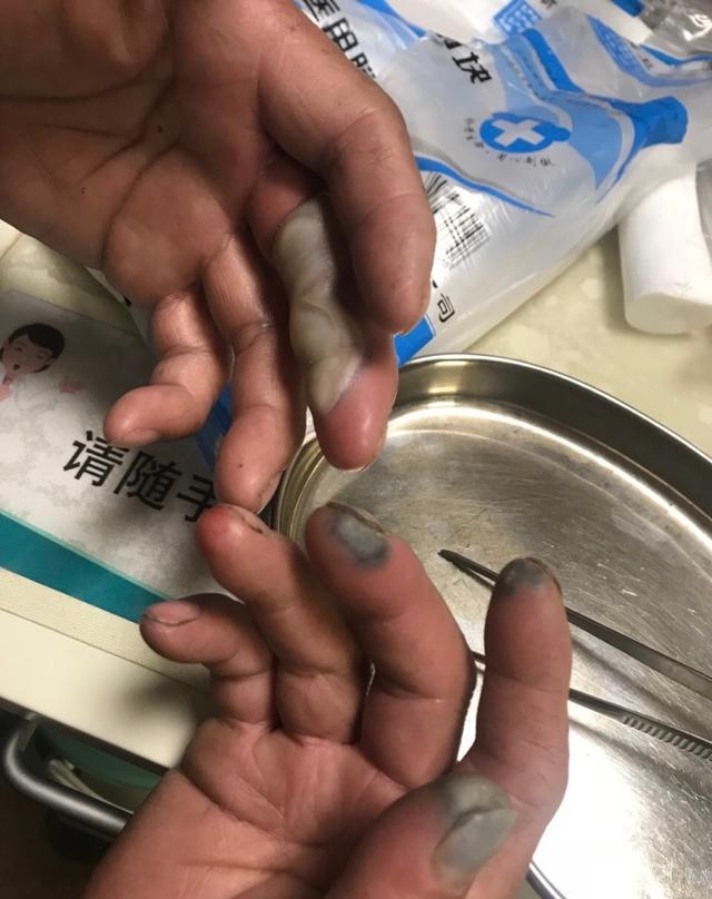 环卫工除夕夜清运垃圾 手指遭剧毒氢氟酸腐蚀