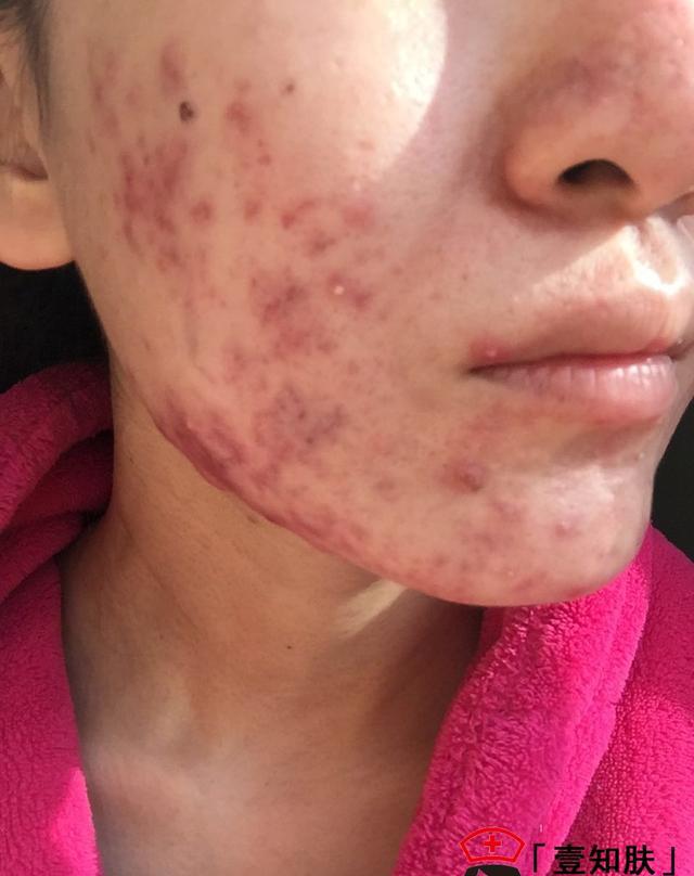 成功赶走痘痘涅盘重生完整记录一个女生的战痘经历