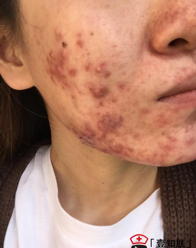 成功赶走痘痘涅盘重生完整记录一个女生的战痘经历