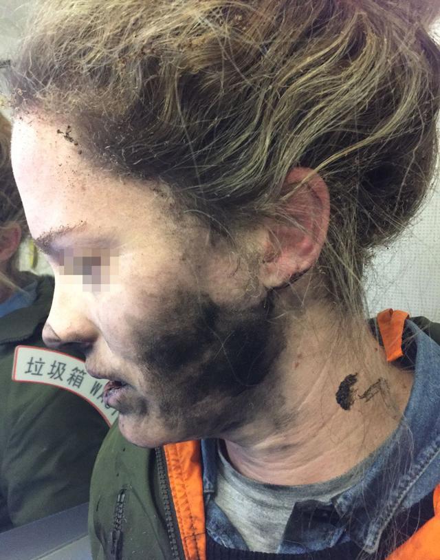 女子乘飞机睡梦中被耳机烧焦头发 烧黑脸