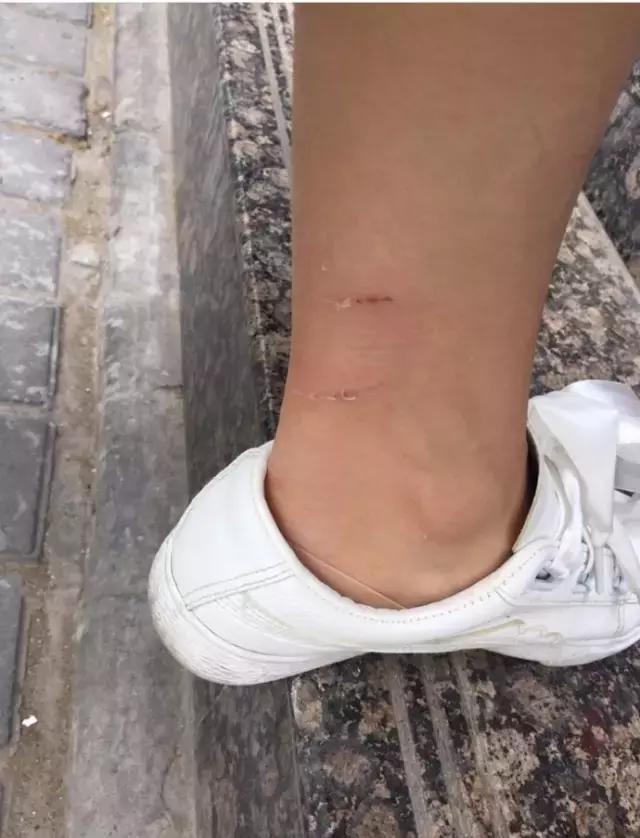 西安女子被狗咬28天后死亡丈夫为何打了疫苗也没用