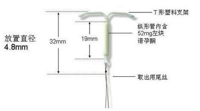 女人上环过程是这样的有哪些情况是不适合的