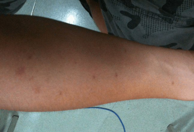 皮肤上出现这些症状说明你可能患上了肝病