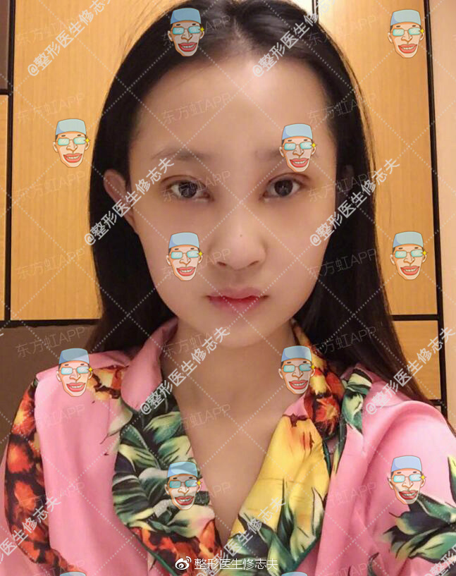 歪鼻修复术后40天恢复日记:从沮丧煎熬到欣喜