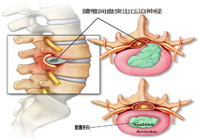 再不注意就晚了|腰椎间盘突出|腰痛|髓核_新浪新闻