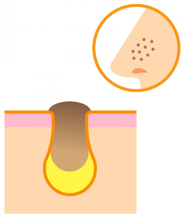 5种自然的方式来疏通不同类型的皮肤毛孔