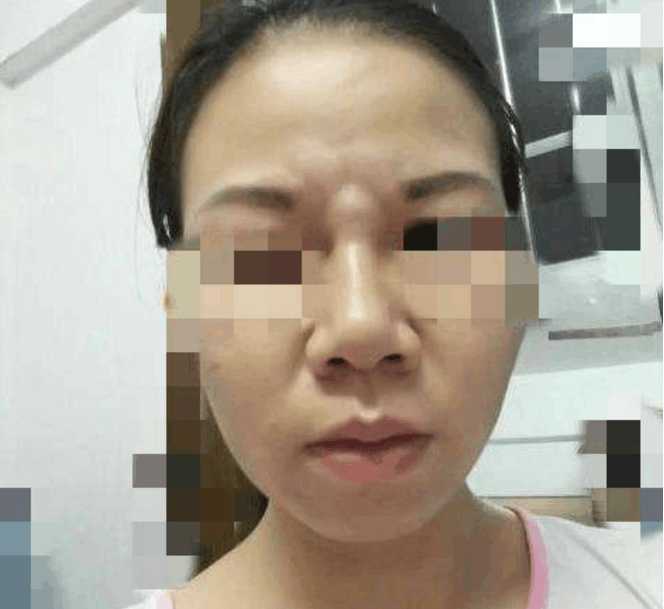 女子鼻子鼓出一个大包, 医生从大包里扯出十几条"虫子"
