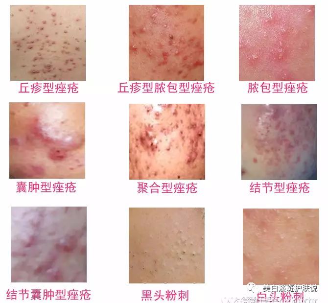 朵嘉浓剑萍(4976981):面部痤疮怎么治疗护理与预防