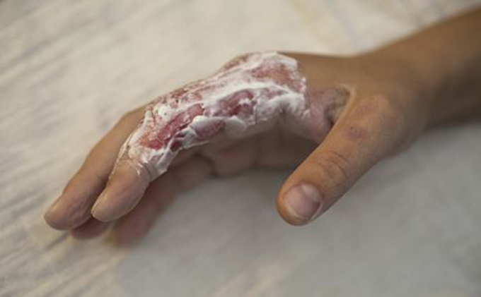 过年放鞭炮我把侄子手炸伤回家侄子一直哭婆婆看后却感谢我