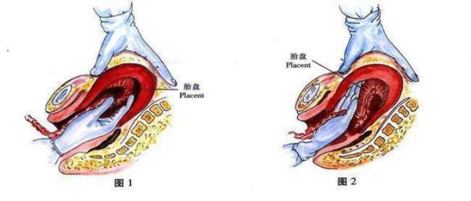 产妇刚顺产完双胞胎,男医生却把手伸进产道掏了20分钟,当场疼晕