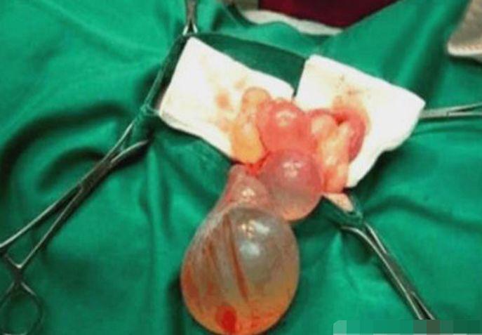 90后孕妇肚子里藏着个"球", 医生检查后吓到腿软, 真相让人傻眼