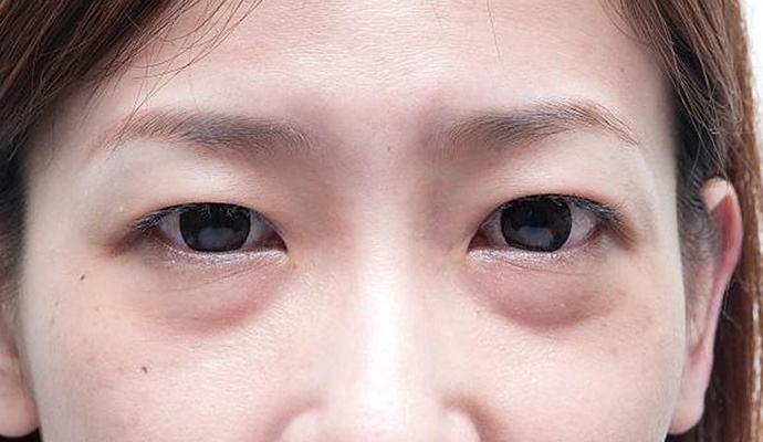 便宜的阿司匹林加"一物",居然10天能淡化眼袋,20天眼袋就没了