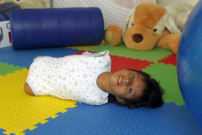 直击8张罕见的四肢全无女孩的催泪照