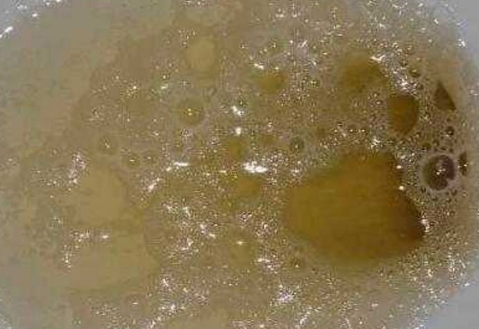 不论男女,尿液一旦发生这样的改变,就要留意了,可能是大病来临