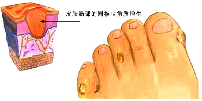 好一朵美丽的茉莉花嚼碎敷鸡眼三天见效百试百灵快收藏