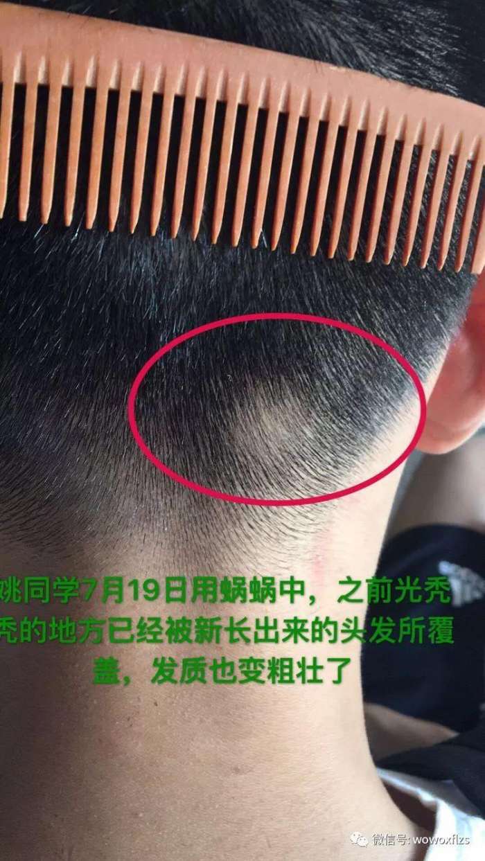 斑秃是什么原因引起的