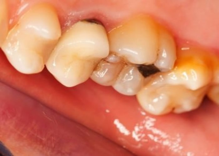 科学家研究指进餐时饮用酸性饮料牙齿严重腐蚀机会高11倍