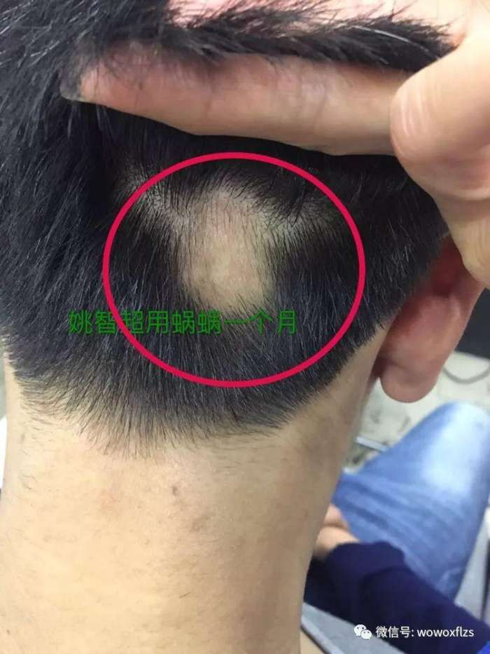 斑秃是什么原因引起的