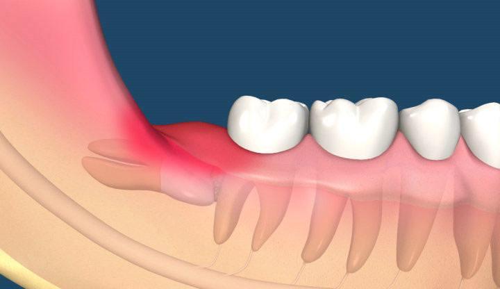 牙龈肿痛如何找上门如何应对它网友你的问题答案在这里